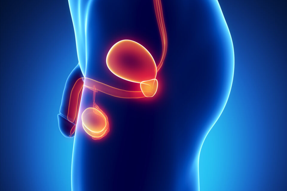 Le cancer de la prostate touche de nombreux hommes, en particulier après 50 ans.