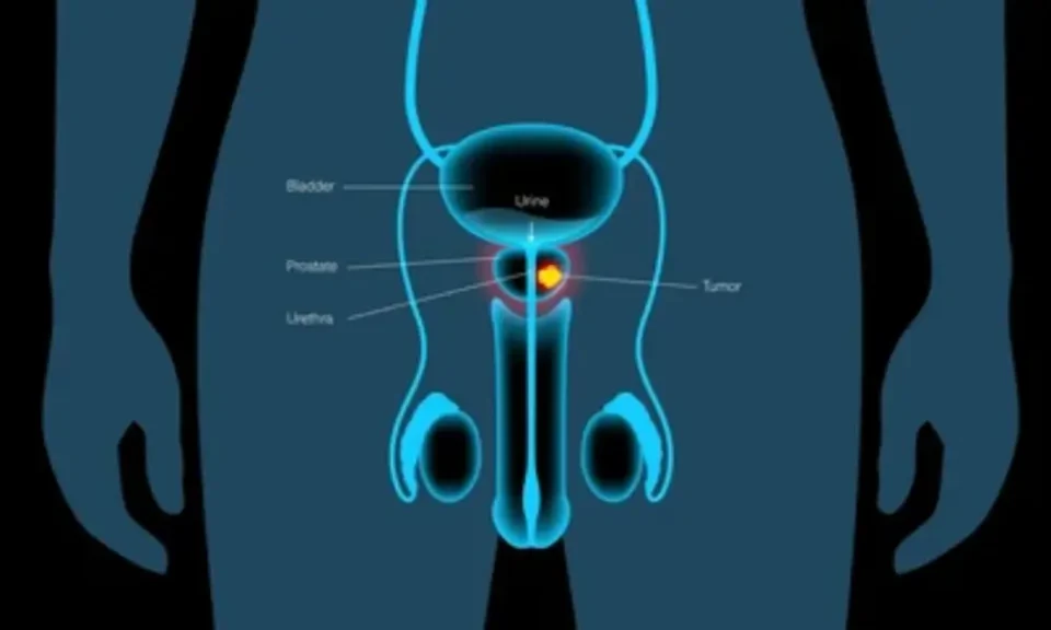 Le cancer de la prostate est le cancer masculin le plus fréquent au Bénin, avec une prévalence de 18,2 % selon le rapport 2020 de l’Organisation mondiale de la santé.